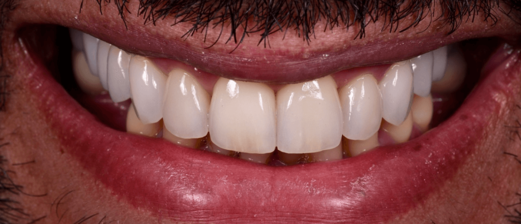 Réhabilitation esthétique dentaire complète après
