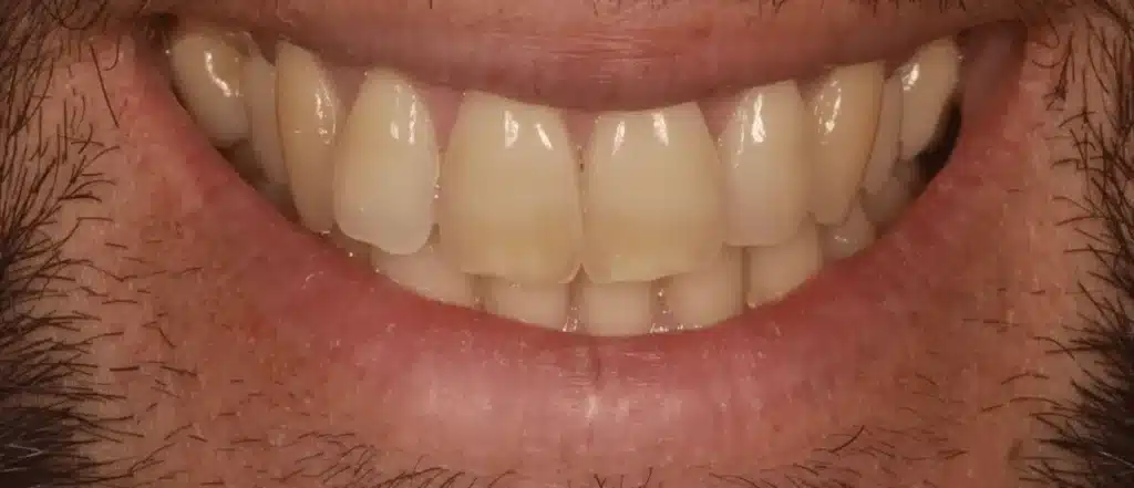 Dentiste Blanchiment dentaire avant