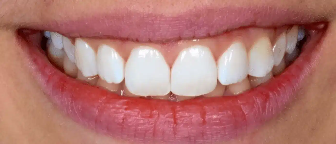 Elimination des taches blanches sur les dents apres