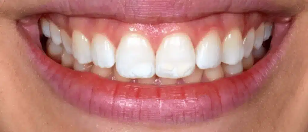 Elimination des taches blanches sur les dents avant