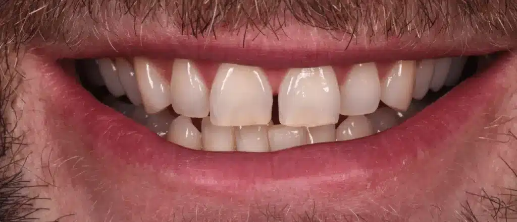 Exemple dentiste greffe osseuse dentaire avant