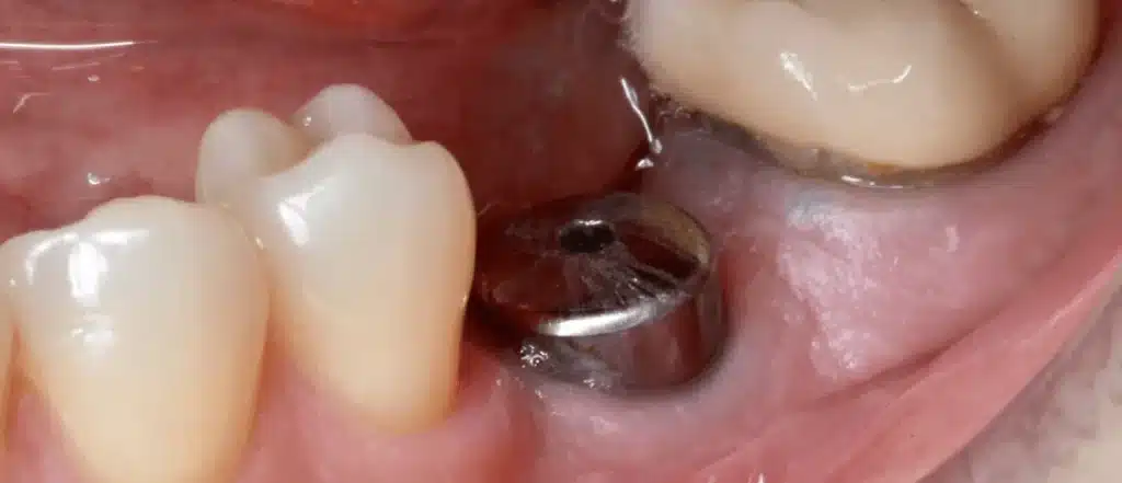 Dentiste implant dentaire Paris après