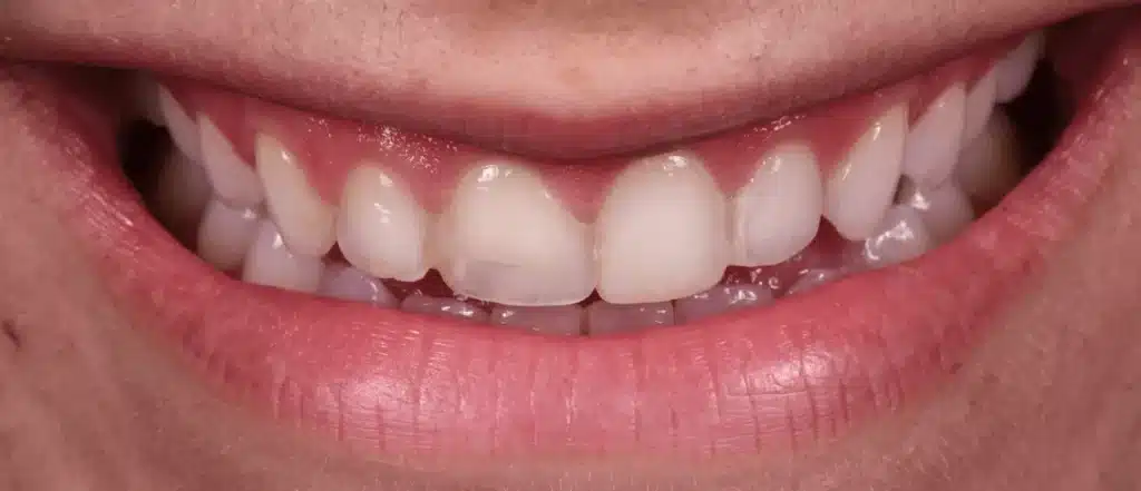 Dentiste greffe osseuse dentaire paris avant