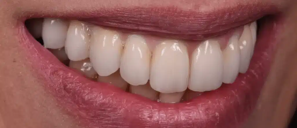 Dentiste Implant dentaire apres