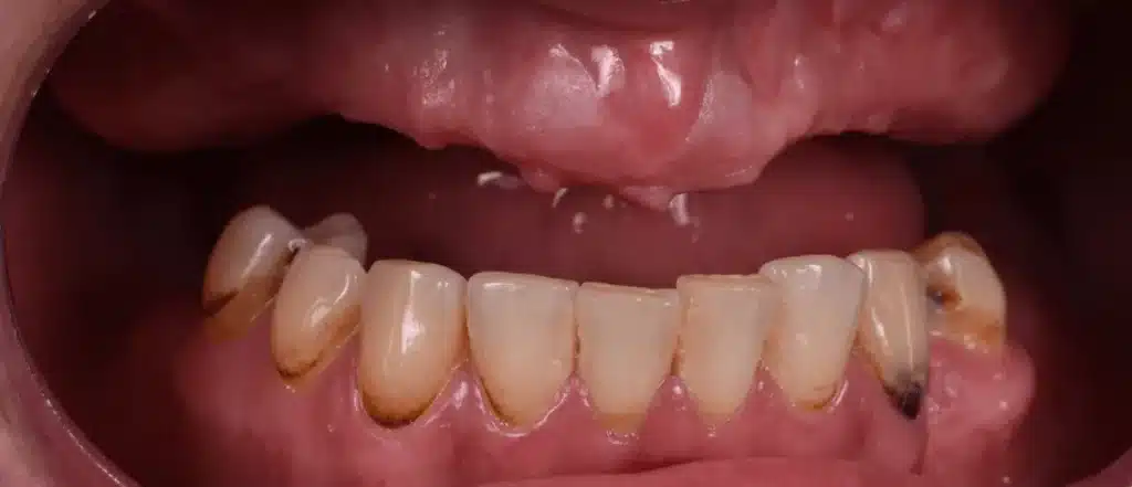 Dentiste Implant dentaire avant