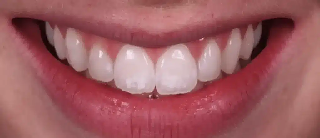 Removing white stains from teeth before