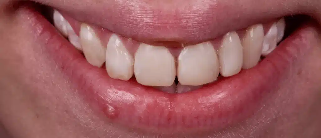 Dentiste facettes dentaires céramiques avant