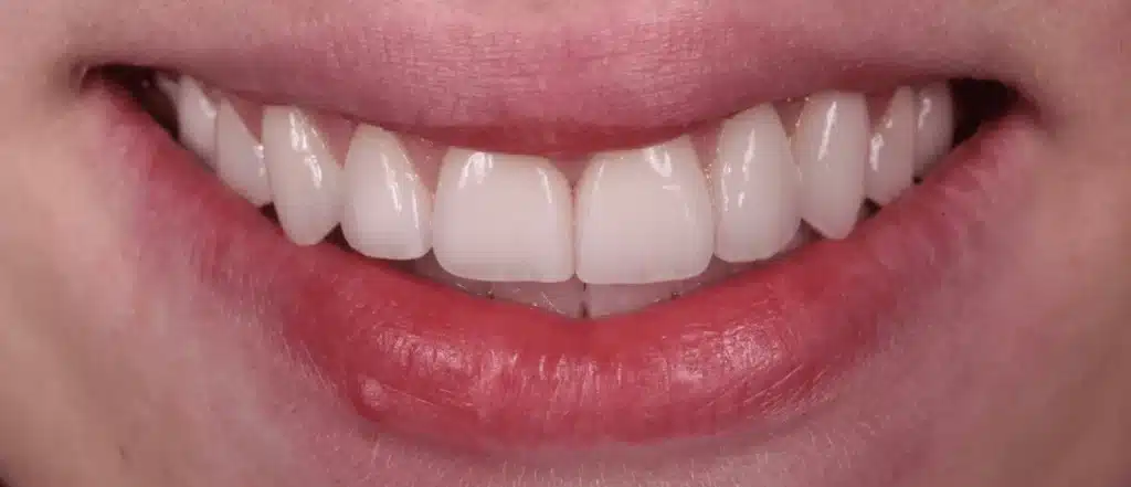 Dentiste facettes dentaires céramiques après