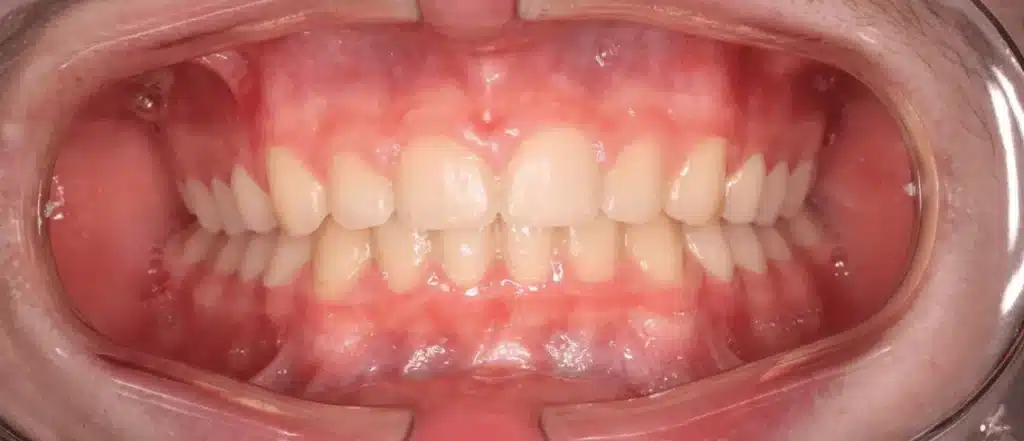 Alignement des dents après orthodontiste paris