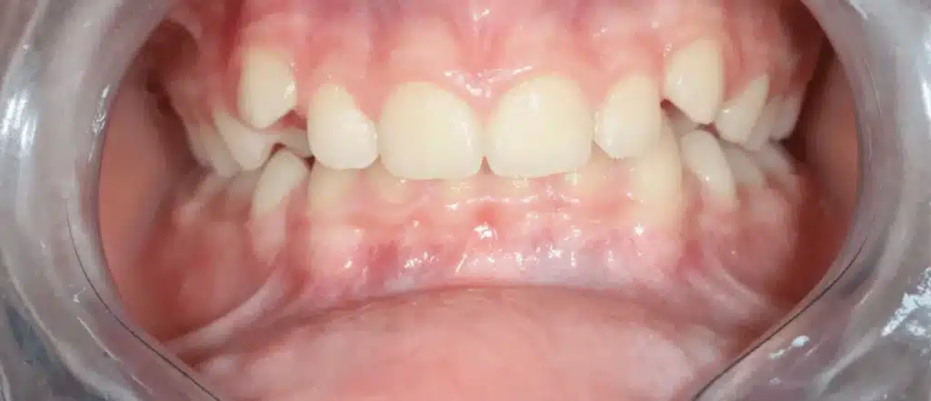 Alignement des dents avant orthodontiste paris