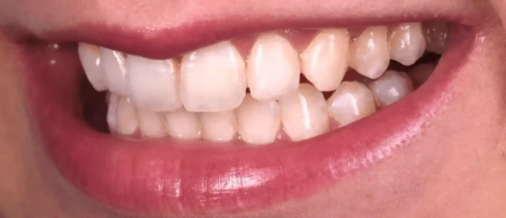 treatment of dental fluorosis after
