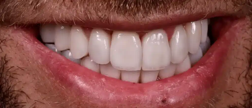 Pourquoi réaliser un bilan bucco-dentaire avant la pose d'une