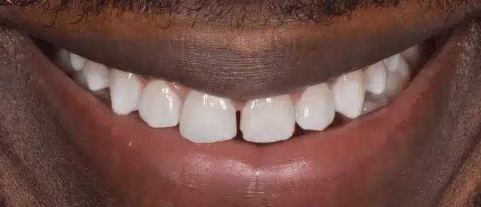 Blanchiment dentaire dentiste paris apres