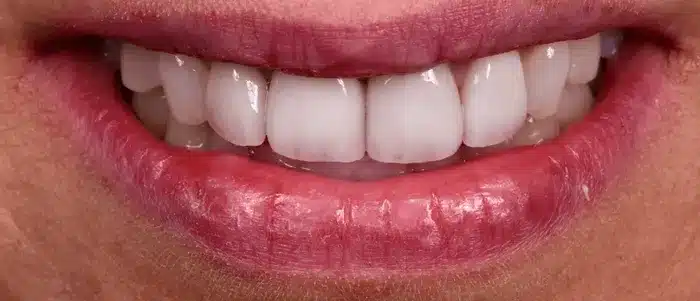 Dentiste blanchiment dentaire paris 9 apres