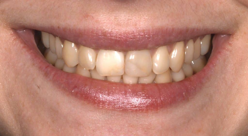 Dents jaunes, avant traitement à la Smile Clinic