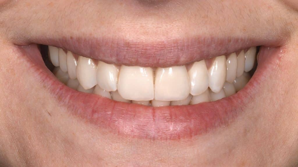 Dents jaunes, après traitement à la Smile Clinic
