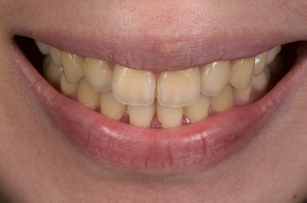Dents jaunes, avant traitement avec Dr. Badaoui