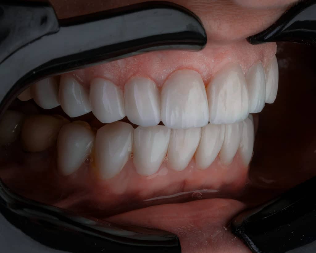 Ecarteur de lèvres chez le dentiste
