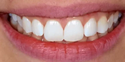 Elimination des taches blanches sur les dents apres