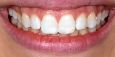 Elimination des taches blanches sur les dents avant