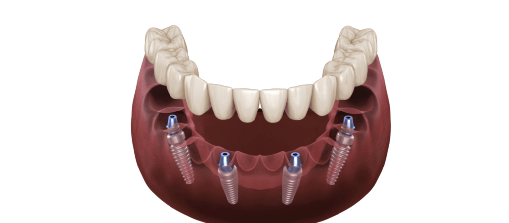 Full-Arch-All-on-4-Dental-Implants