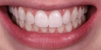 Taches blanches dents apres