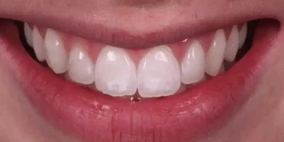 Removing white stains from teeth before