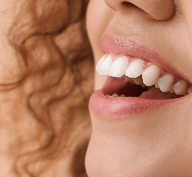 alignement-dent-femme