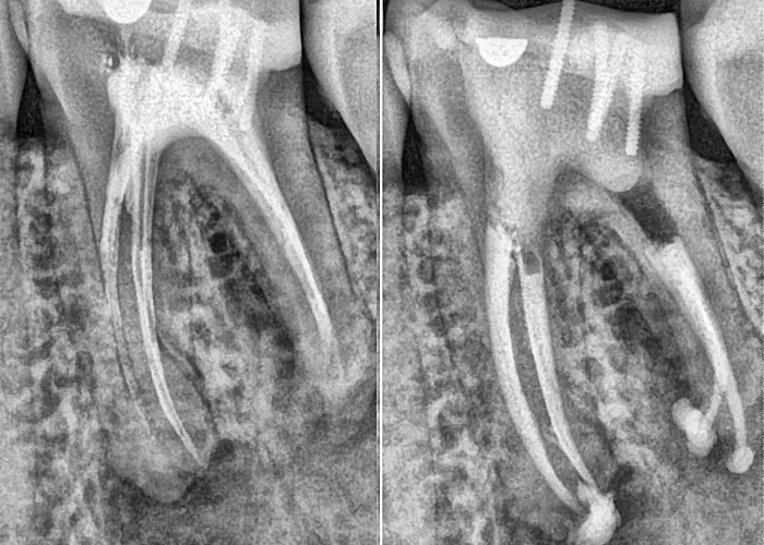 rage de dents douloureuse