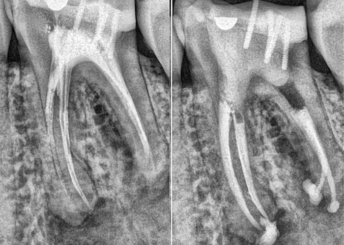 rage de dents douloureuse rage de dents douloureuse
